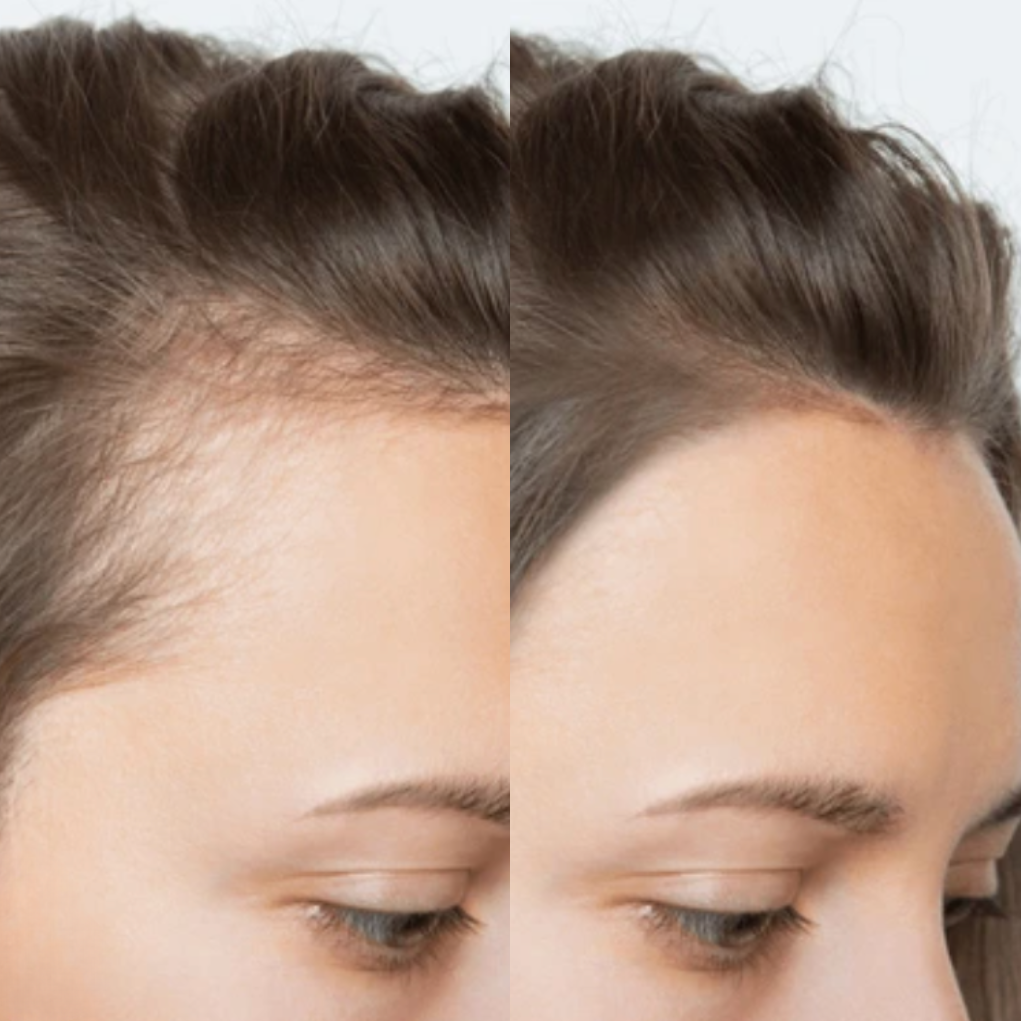 Revive tu Cabello – Tratamiento Anticaída y Crecimiento Tgideas ®